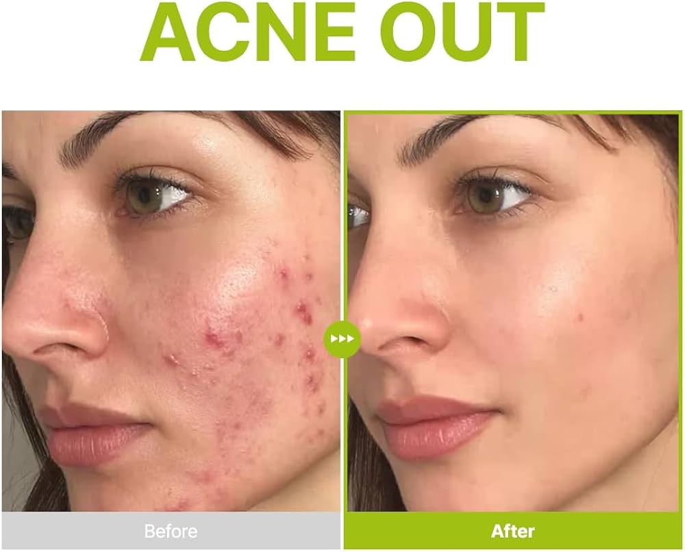 Purito Seoul Azelaic Acid 10 Kojic Tea Tree Serum 30ml